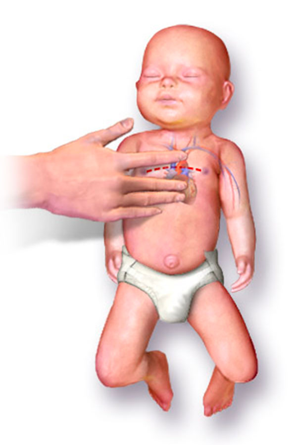 RCP en niños